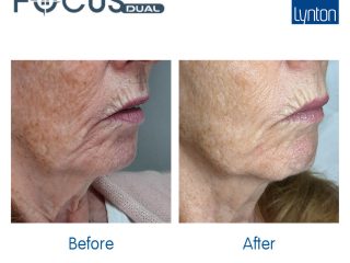 Before and After. Focus Dual. 4. Skin Laxity. Rediscovered Skin Clinic (1)