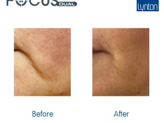 Before and After. Focus Dual. 9. Skin Laxity. HIFU. Clinic 10