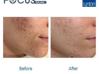 Before and After. Focus Dual. Acne. RFM. Setsuko Beauty