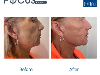 Before and After. Focus Dual. Full Face and Neck. HIFU. Medicare Cosmetics