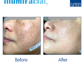 Before and After. illumiFacial. Lumina. Laser Skin Solutions