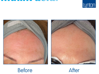 Before and After. illumiFacial. Lumina. Toddington Laser Clinic