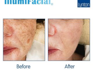 illumiFacial Before and After