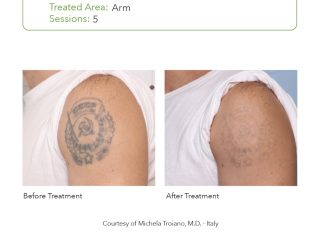 SmartPICO Before & After for Tattoo Removal Treatments