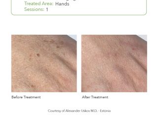 SmartPICO Before & After for Skin Rejuvenation Treatments