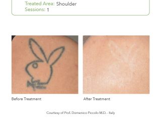 SmartPICO Before & After for body tattoo removal treatments