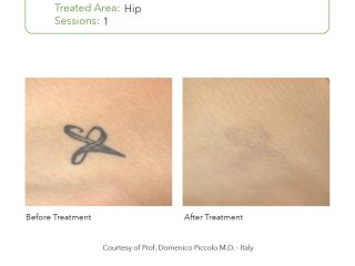 SmartPICO Before & After for body tattoo removal treatments