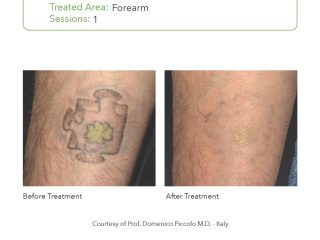 SmartPICO Before & After for arm tattoo removal Treatments