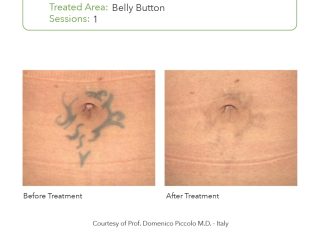 SmartPICO Before & After for body tattoo removal treatments