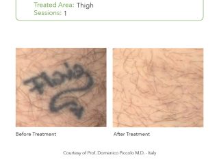 SmartPICO Before & After for leg tattoo removal treatments