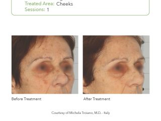 SmartPICO Before & After for Lentigo Treatment