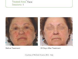 SmartPICO Before & After for Facial Pigmentation Treatments