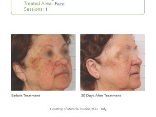 SmartPICO Before & After for Face Pigmentation Treatments