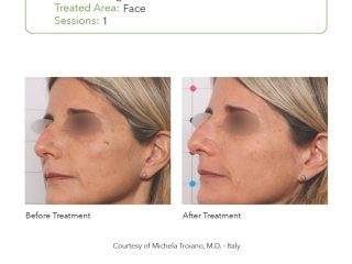 SmartPICO Before & After for Face Pigment Treatments